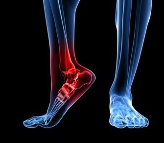 Артроз голеностопного сустава