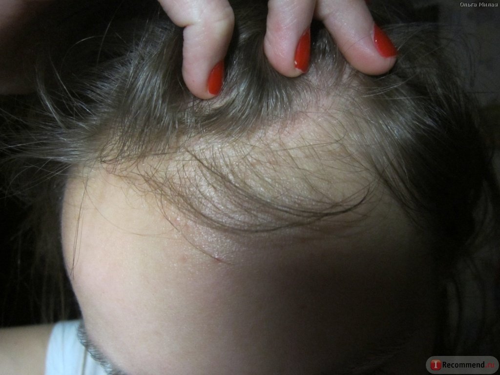 Девушка демонстрирует появившийся подшёрсток