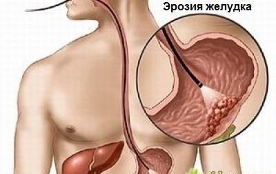 эрозия желудка, схема