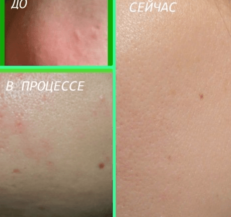 Фото в процессе лечения прыщей