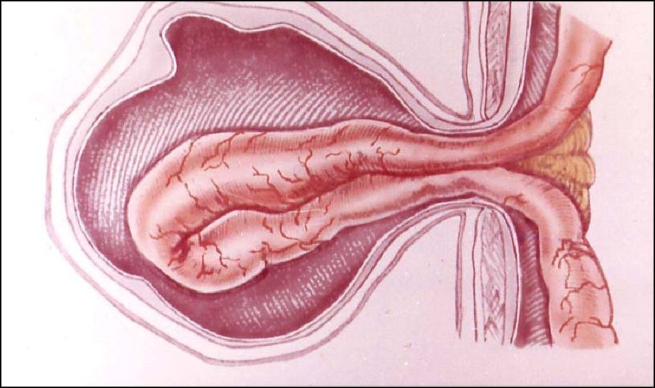 Схематическое изображение паховой грыжи