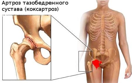 коксартроз