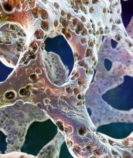 Кость с остеопорозом под микроскопом