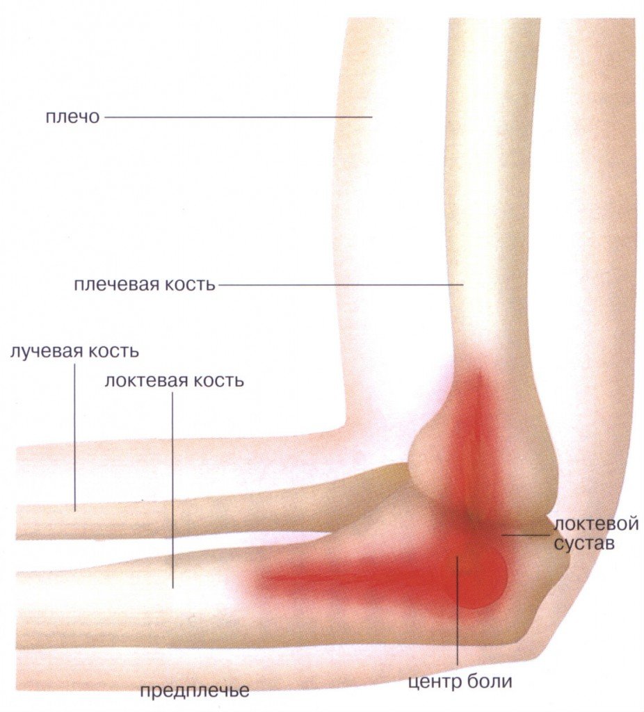 Локоть теннисиста, схема