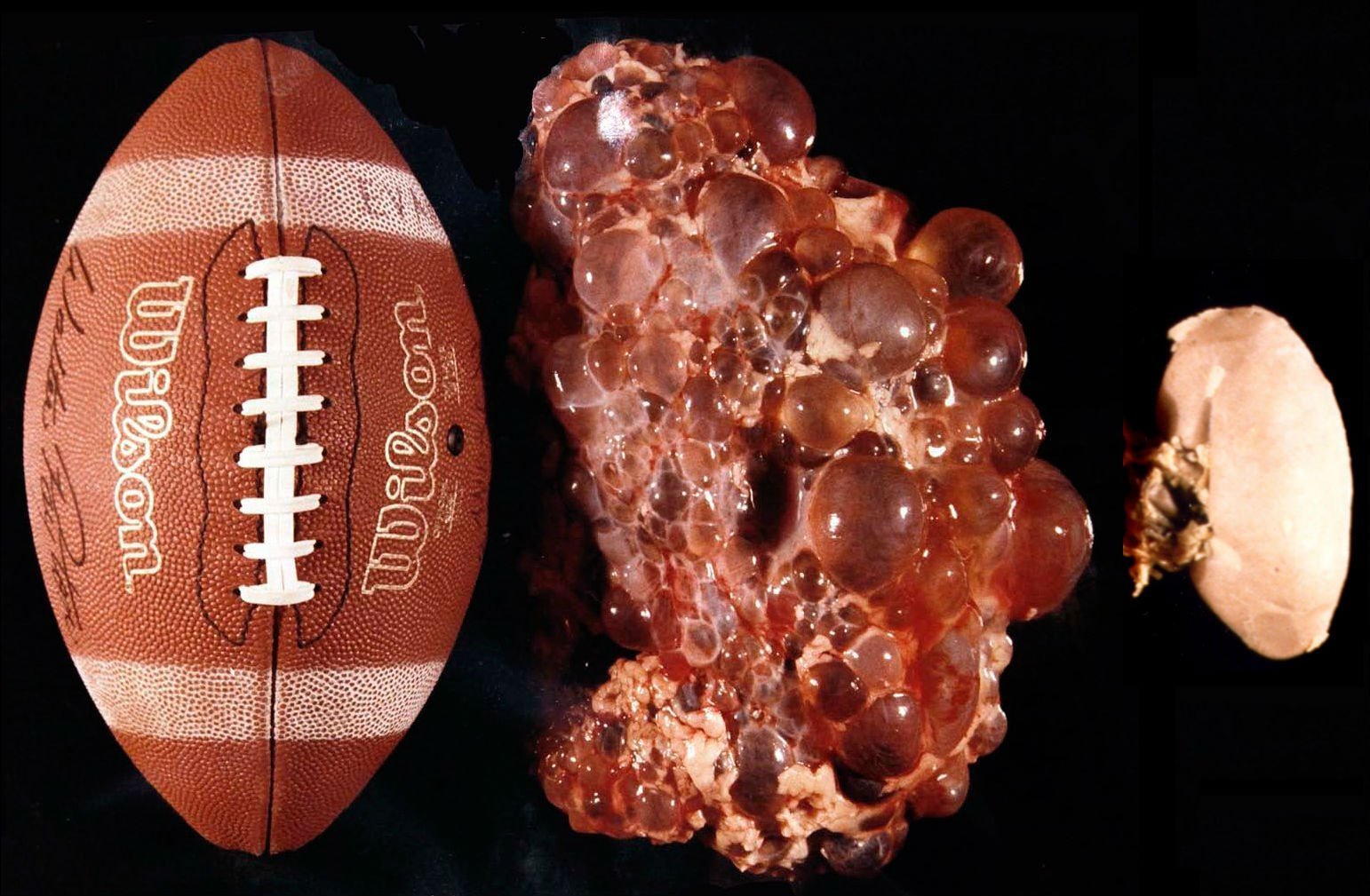 Мяч, почка, поражённая поликистозом, и здоровый орган