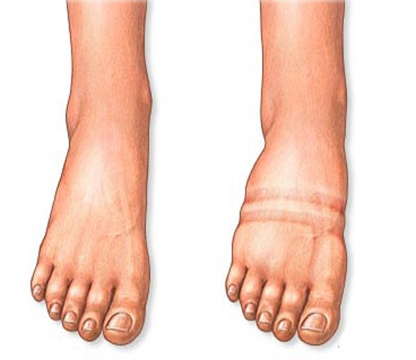 нормальная нога и нога с отёком