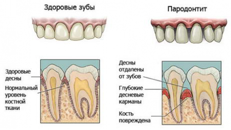 Пародонтит