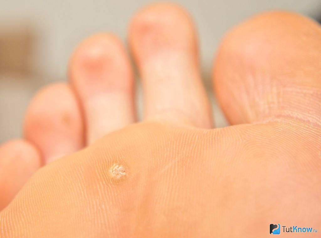 Подошвенная бородавка