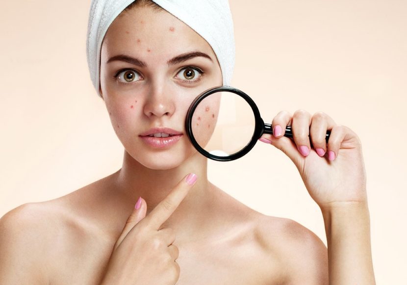 Прыщи под лупой на лице у девушки