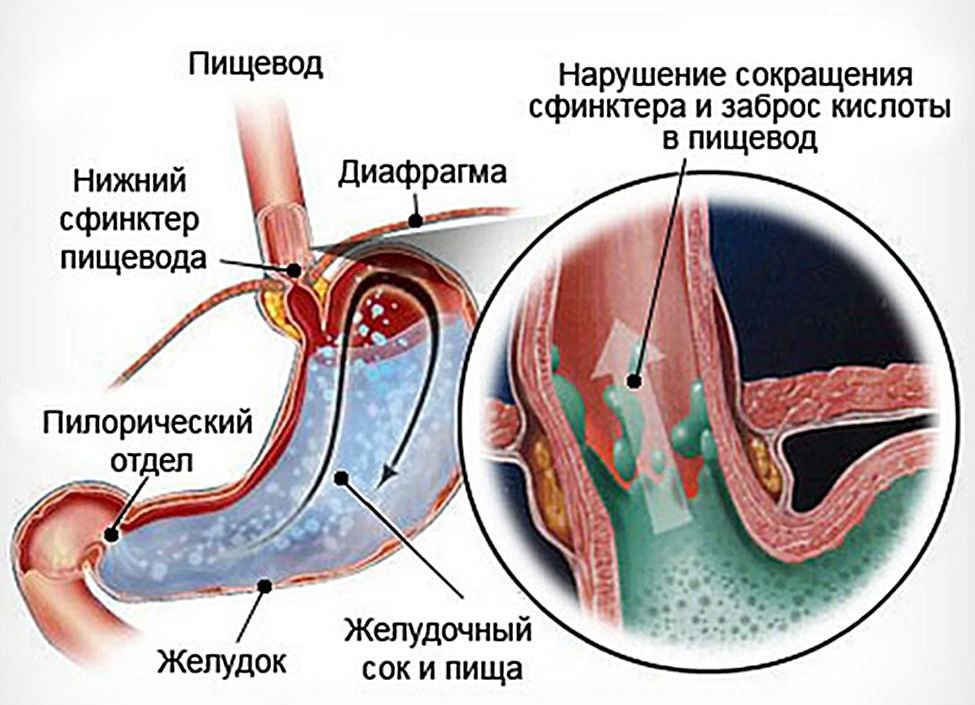 Схема протекания рефлюкс-эзофагита