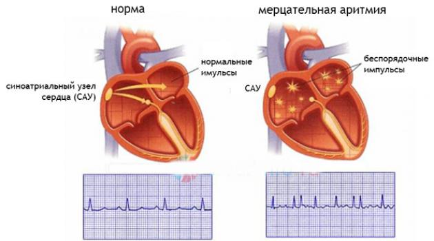 Схема: здоровое сердце и сердце с мерцательной аритмией