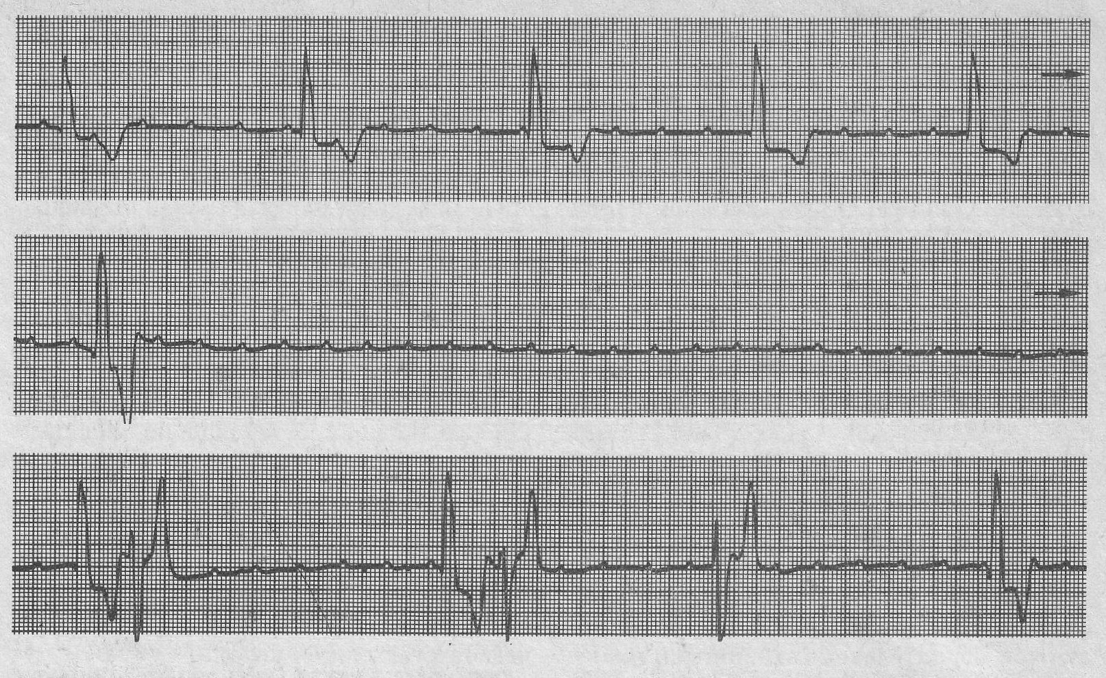 Синдром Морганьи-Эдамса-Стокса на кардиограмме