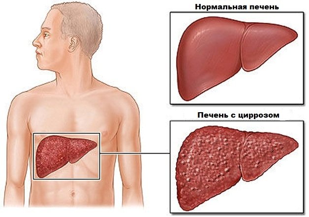 Схематичное изображение цирроза печени