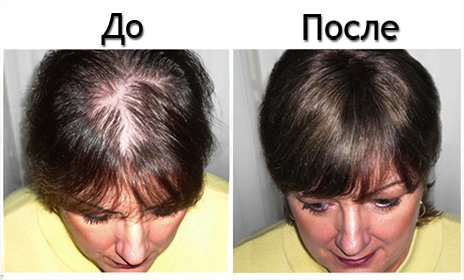Состояние волос при облысении и после лечения