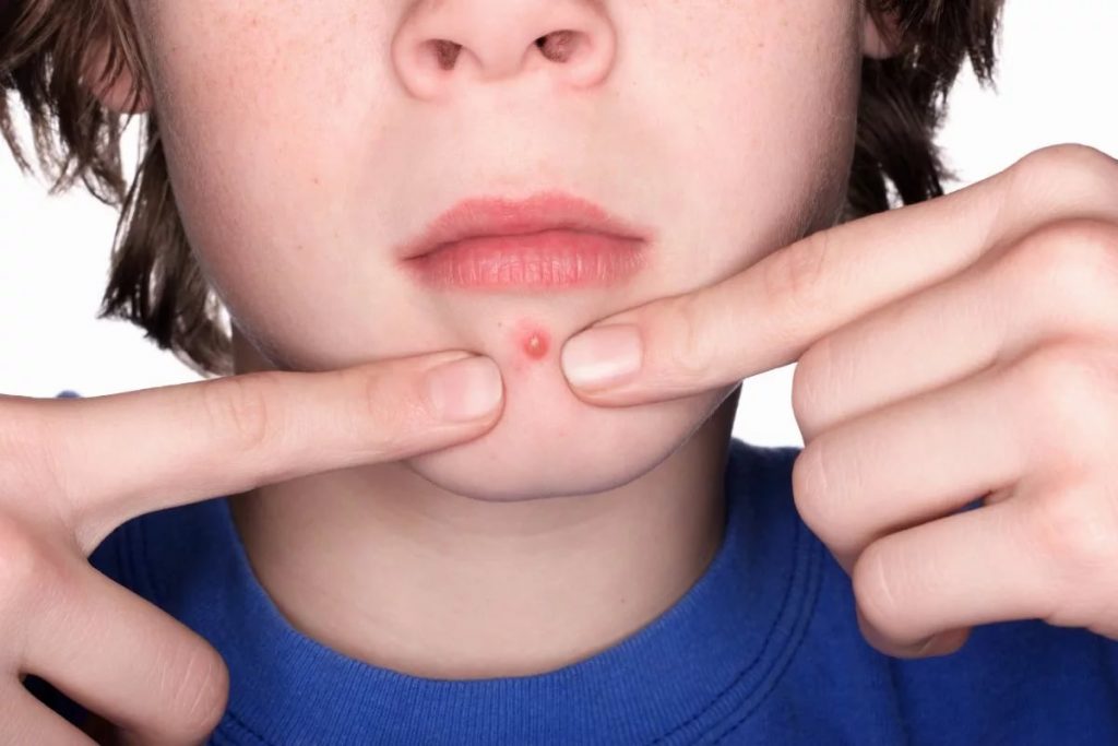 Прыщ на подбородке