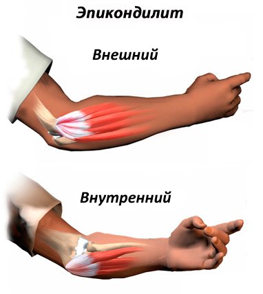 Внешний и внутренний эпикондилит, схема