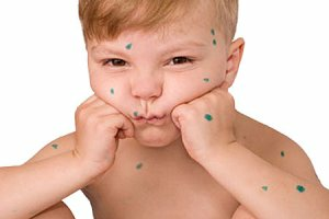Лечение ветрянки у детей