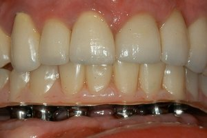 Протезирование зубов при отсутствии большого количества зубов