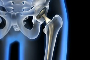 Осложнения после замены тазобедренного сустава