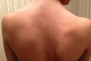 Прыщи на спине