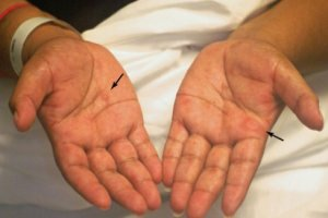 Как передается сифилис