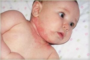 Потница у новорожденных: эффективные способы лечения