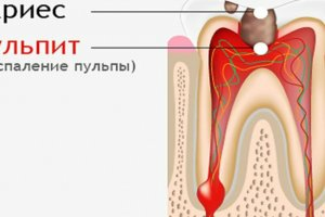 Пульпит зуба