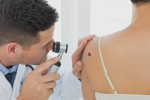 Лазерное удаление родинок