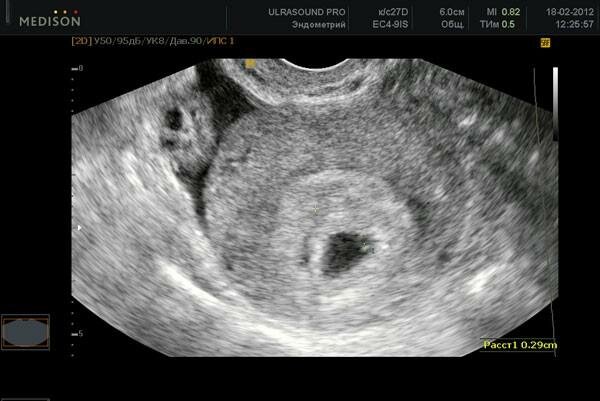 УЗИ 4 недели беременности